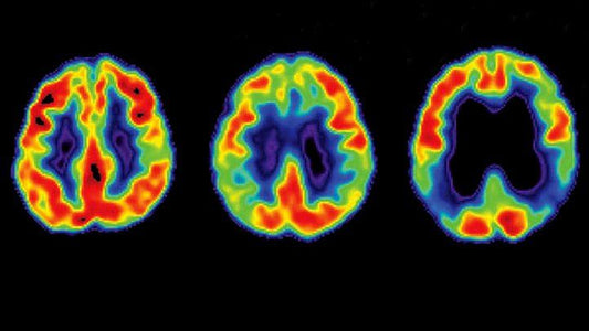 Acetylcholine And Alzheimer’s Disease