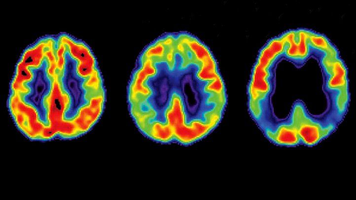 Acetylcholine And Alzheimer’s Disease